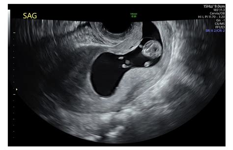 ulmf preg|Pregnancy v2.9 .